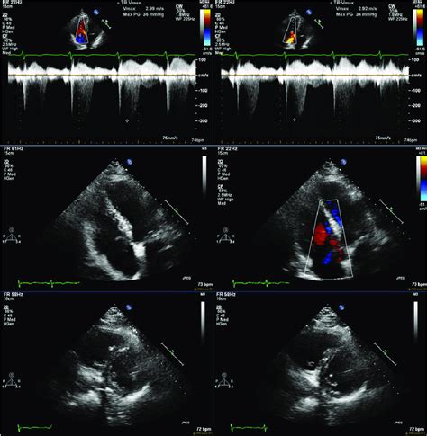 ejection fraction 60-65